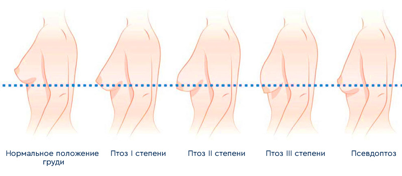 схема птоза груди, которая является показанием к подтяжке груди