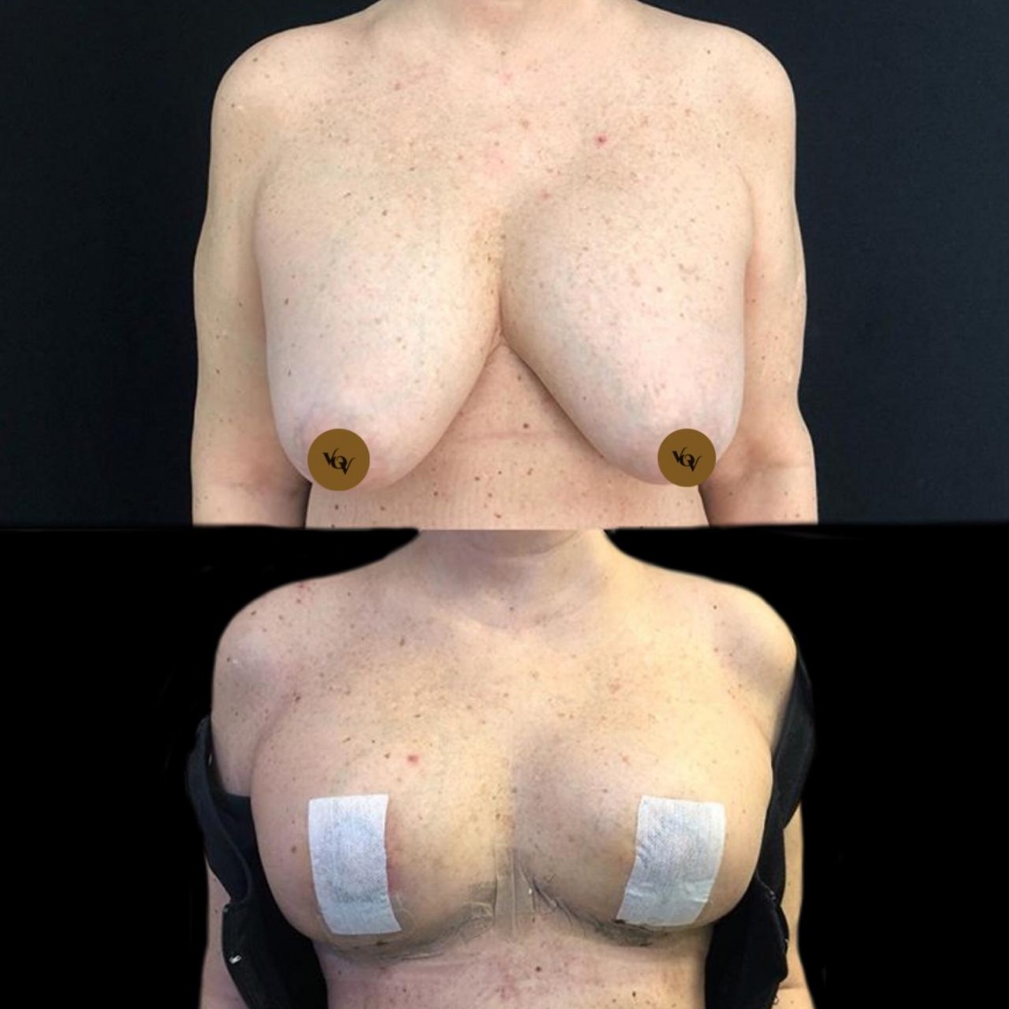 удаление грудных имплантов методом en bloc