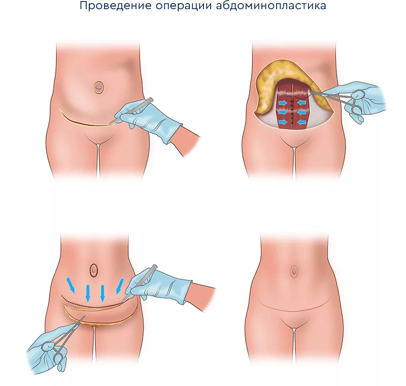схема разрезов живота в 4 этапа при проведении абдоминопластики