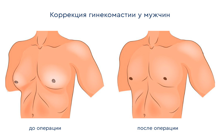 схема: мужская груди при гинекомастии и после проведенной операции