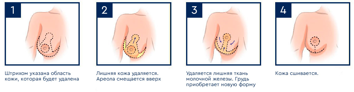 схема: как проводится мастопексия