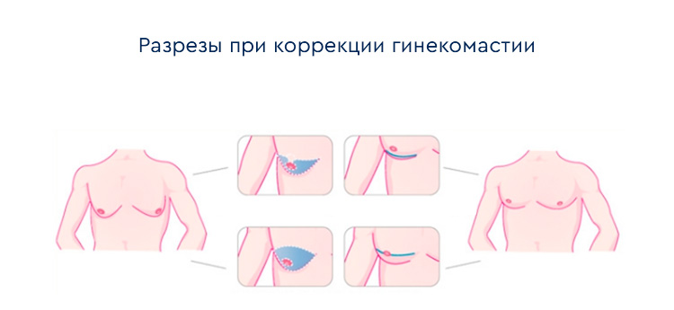 схема: разрезы при коррекции гинекомастии
