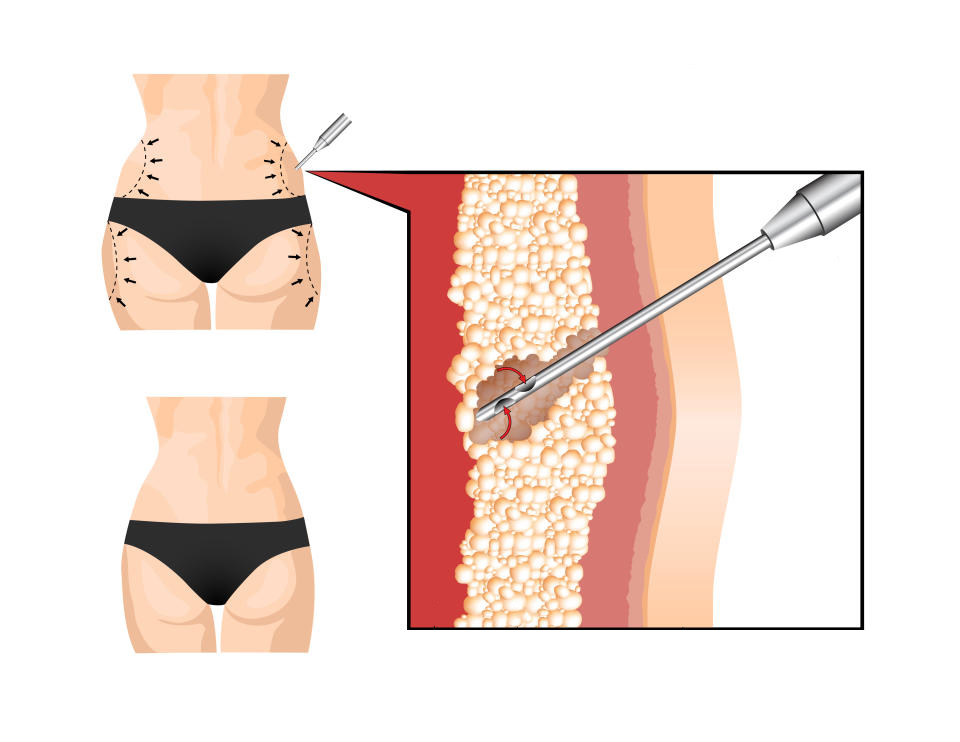 механизм липосакции зоны галифе
