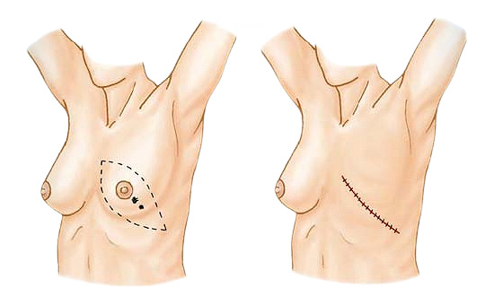 схема: удаление грудной железы